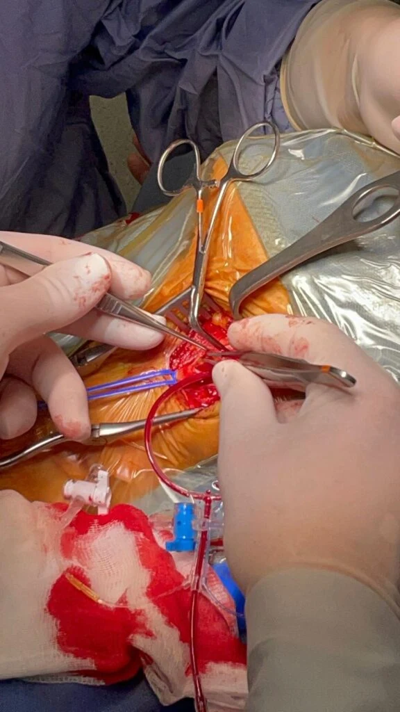 Immagine di approfondimento: Endoarterioctomia Carotidea con il monitoraggio cerebrale intra operatorio